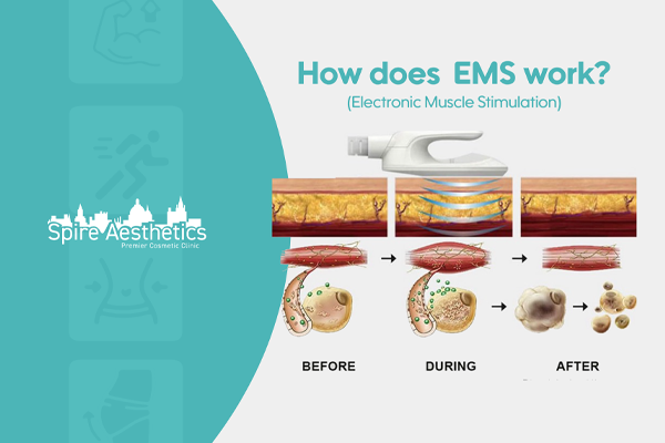 EMS treatment for post pregnancy weight loss treatment Streatley