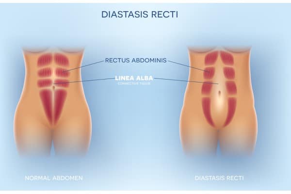 How Does Non-Surgical Treatment Help With Loose Skin, Weak Abdominal Muscles and Post-Pregnancy Changes Streatley?
