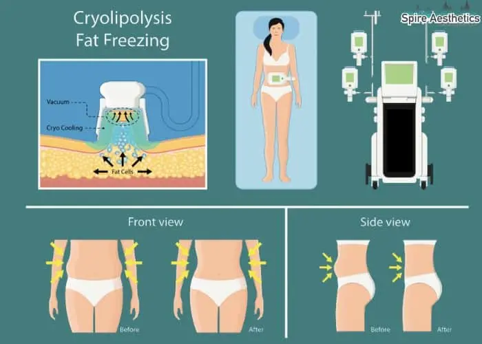 Fat freezing treatment Streatley benefits for competitions to remove stubborn fat deposits.