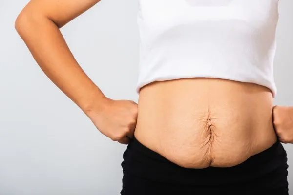 Image of a woman's stomach after weight loss with sagging skin following a gastric band Streatley