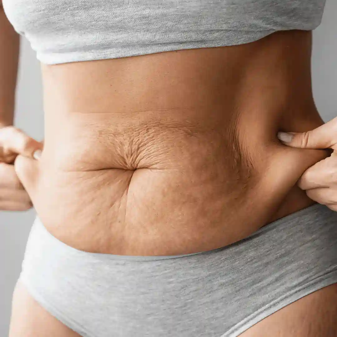 Is It Normal to Have Loose Skin After Pregnancy Streatley?