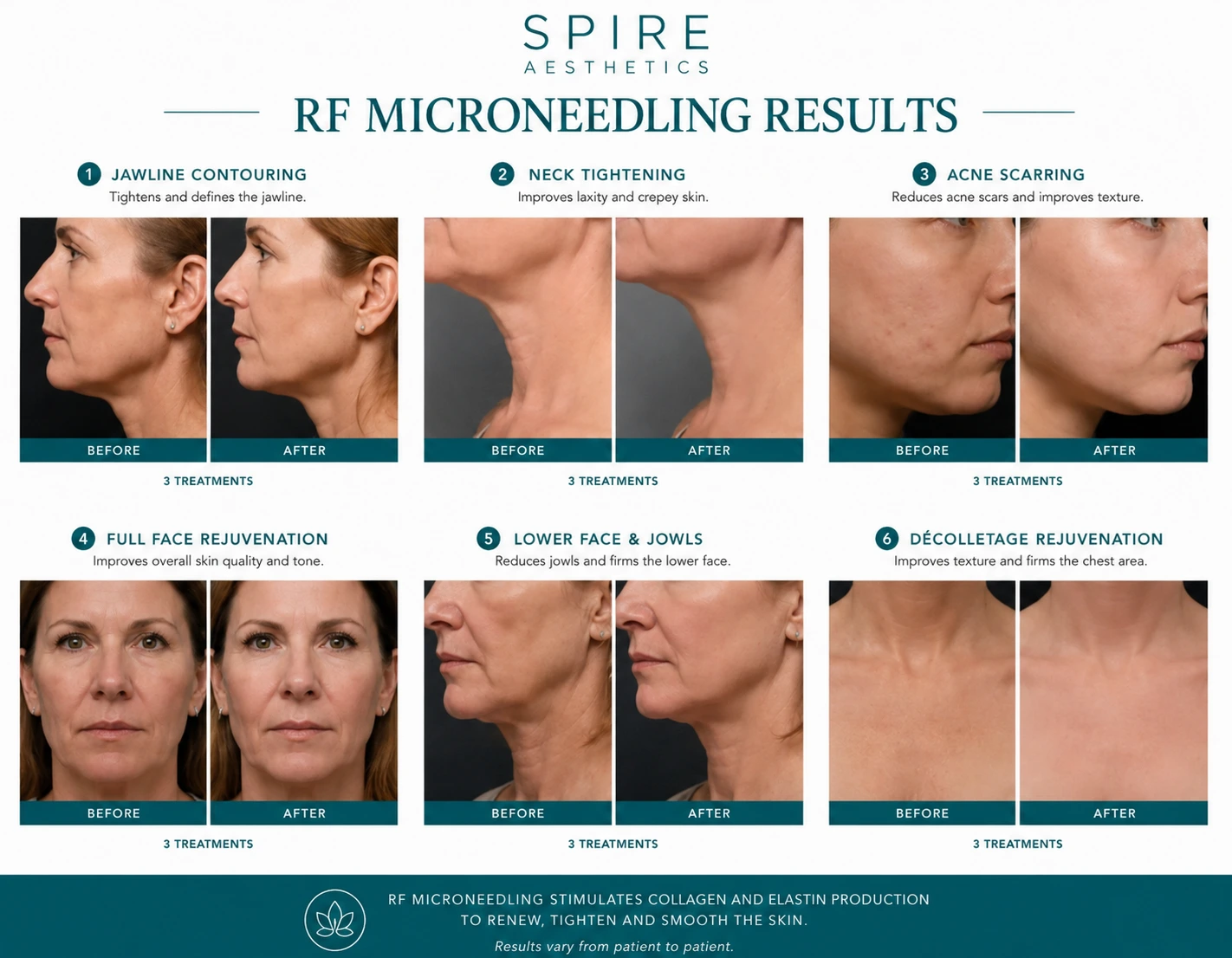 RF Microneedling Skin tightening Streatley results