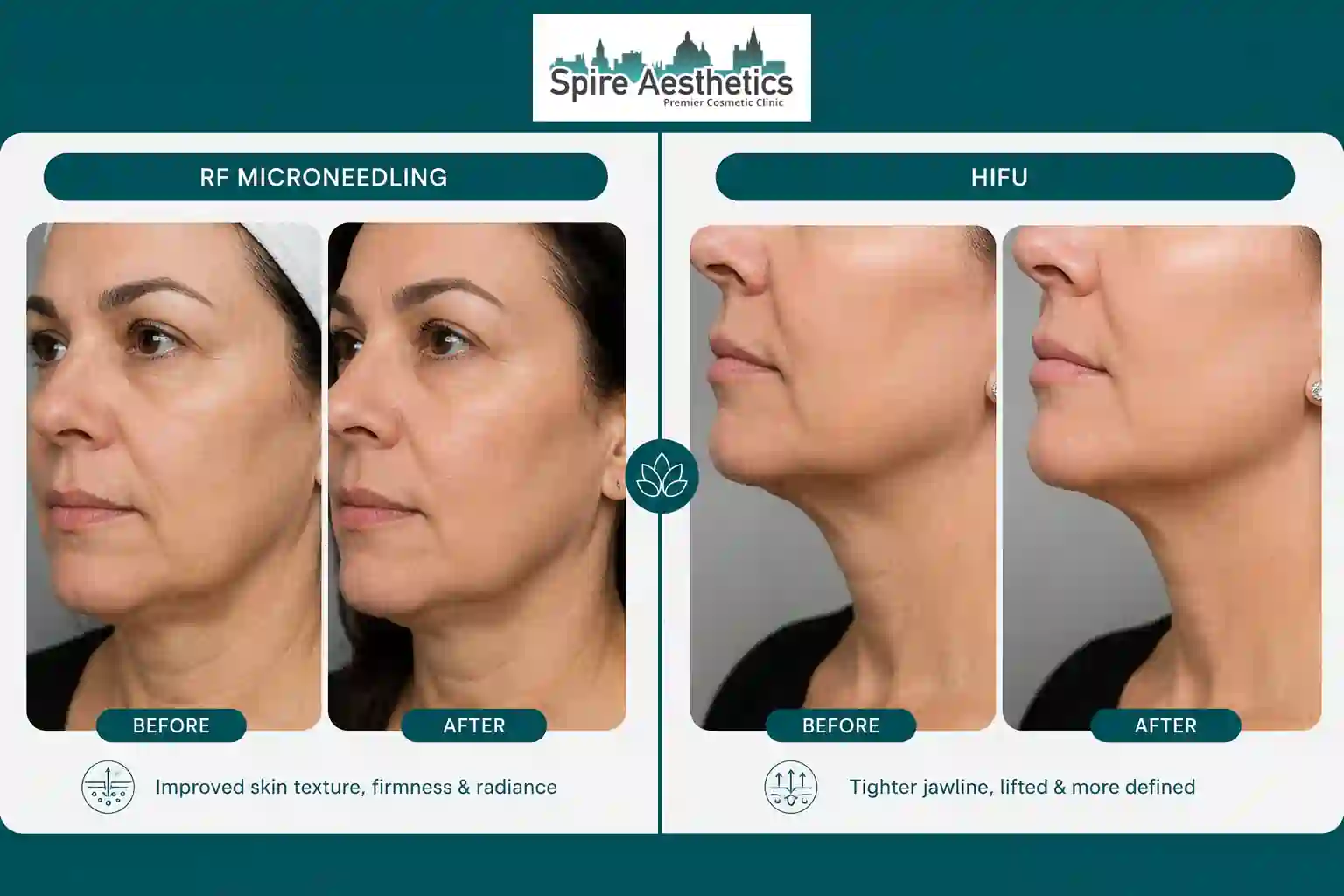 Can RF Microneedling and HIFU Be Combined Streatley?