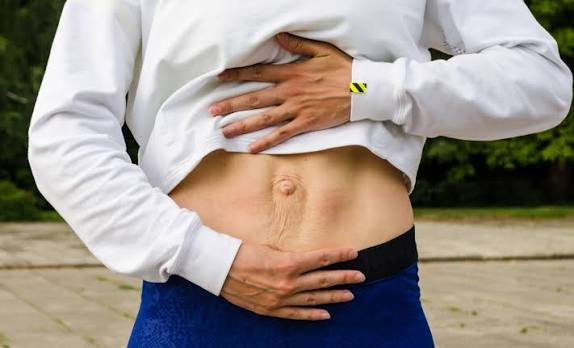 When Could Diastasis Recti Be the Missing Piece of the Puzzle Streatley?