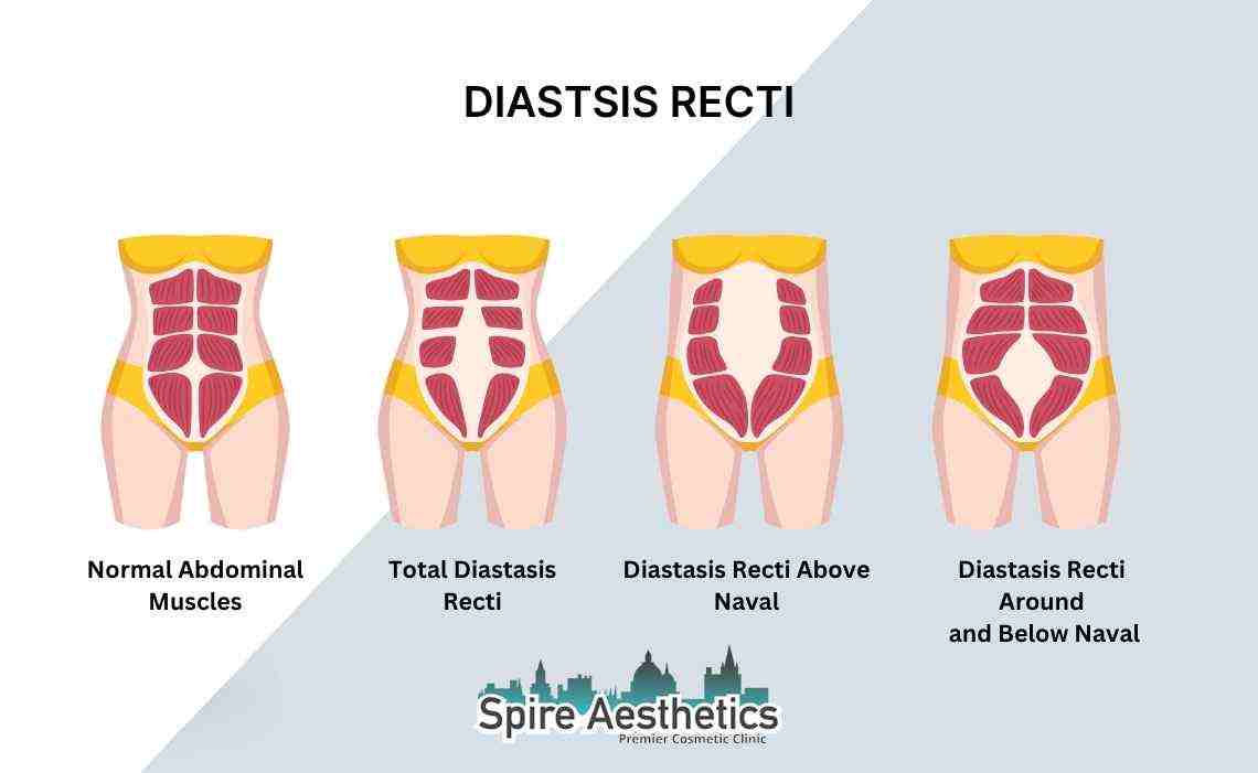 Is Non-Surgical Diastasis Recti Treatment Right for You? Common Concerns Answered Streatley